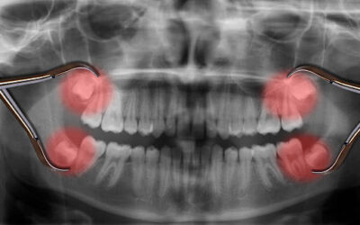 Como tirar o dente do siso? Veja como a cirurgia de extração funciona!